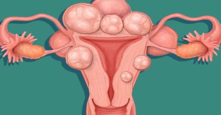 Uterine Fibroids: All you need to know