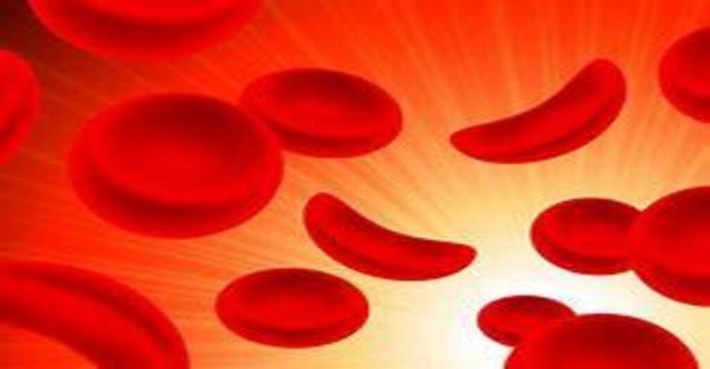 sickle cell